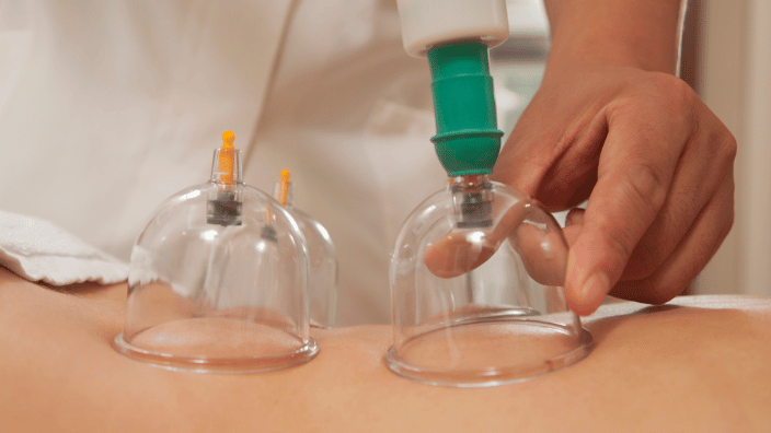 massage therapist performing cupping therapy